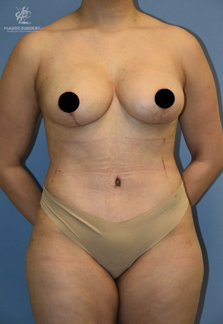 Mommy Makeover, patient 5, after, view 1