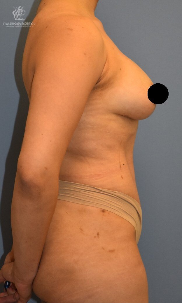Mommy Makeover, patient 5, after, view 3