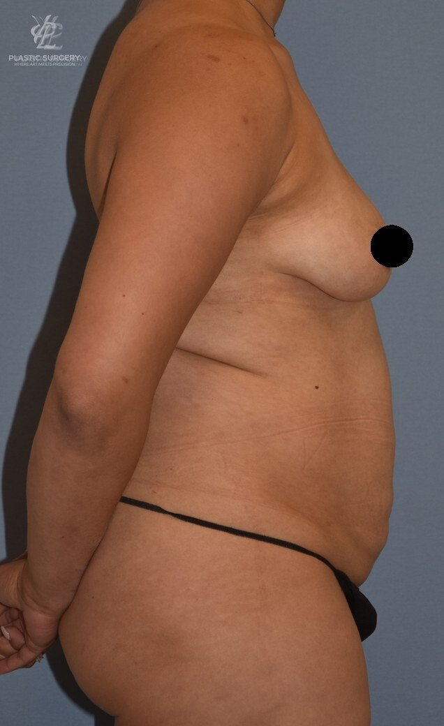 Mommy Makeover, patient 5, before, view 3