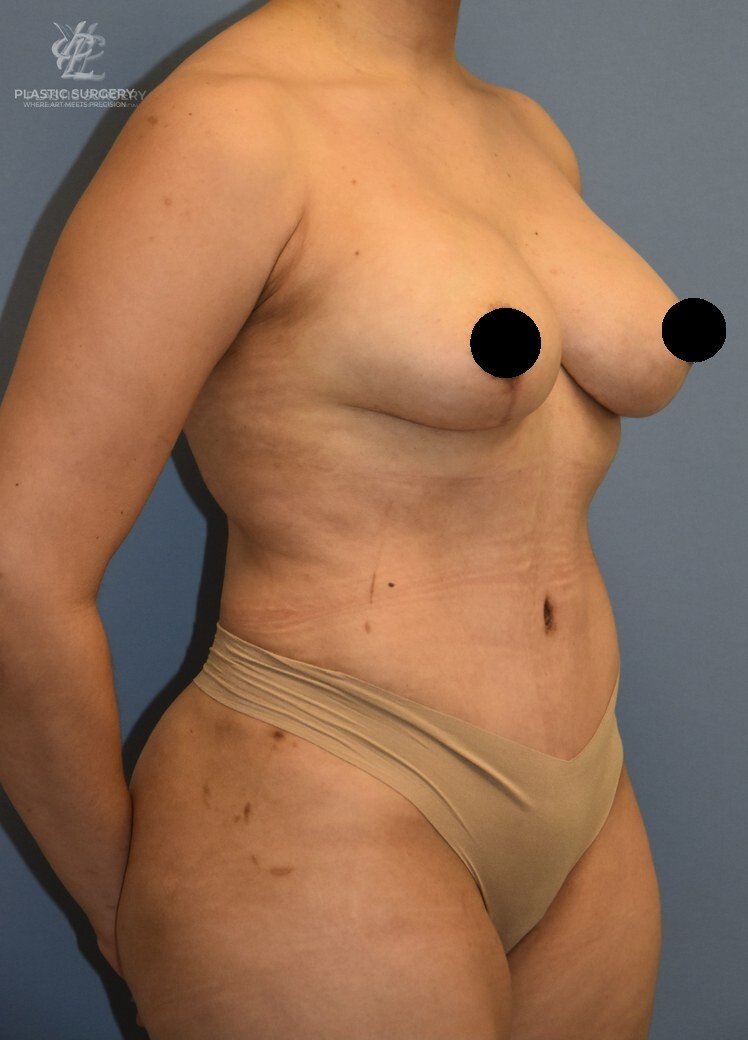 Mommy Makeover, patient 5, after, view 2