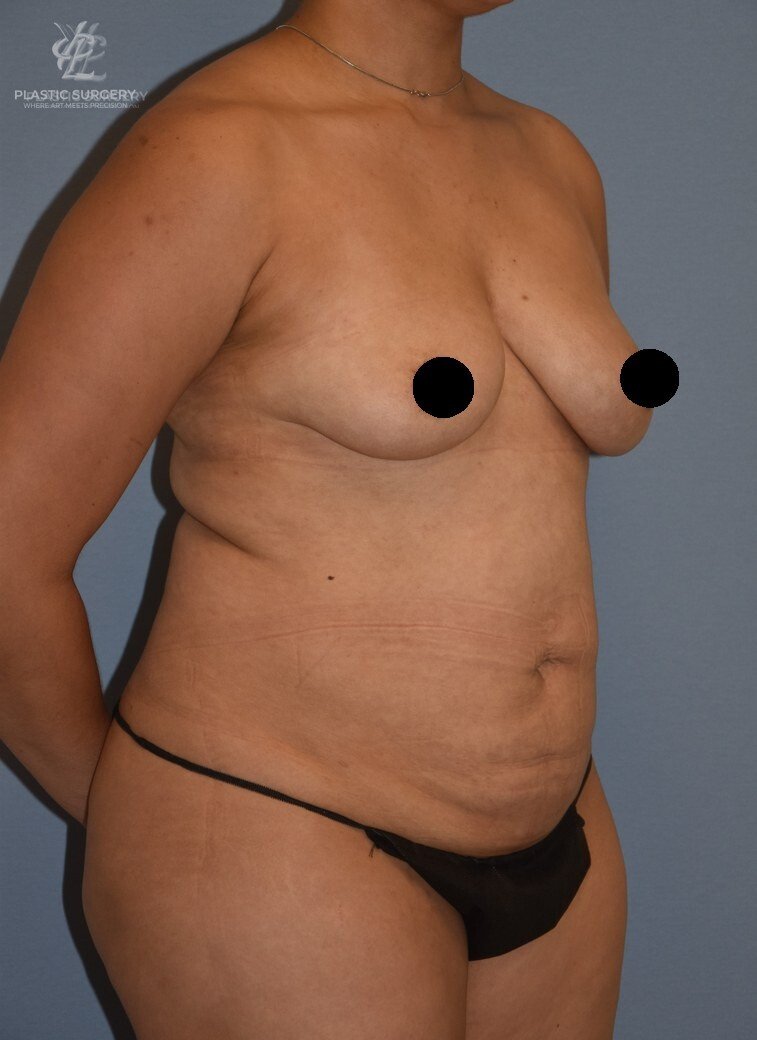 Mommy Makeover, patient 5, before, view 2