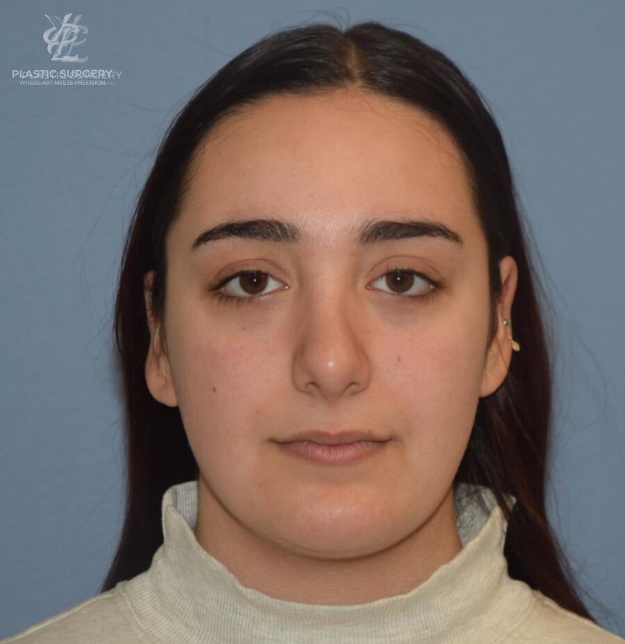 Rhinoplasty, patient 1, after, view 1