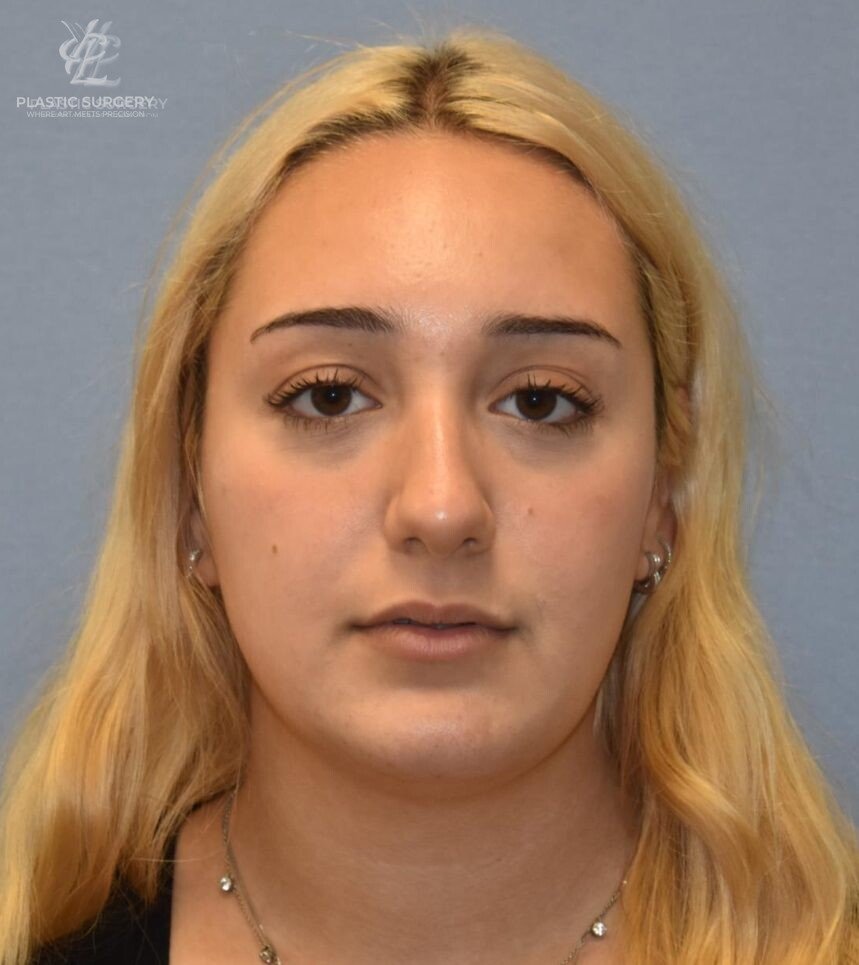 Rhinoplasty, patient 1, before, view 1