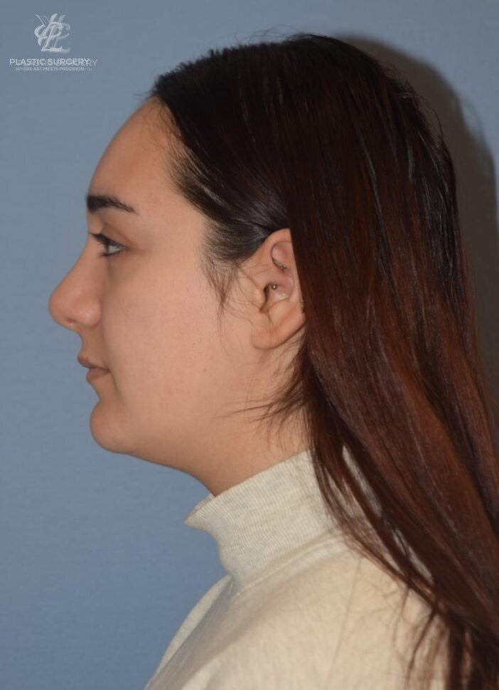 Rhinoplasty, patient 1, after, view 2