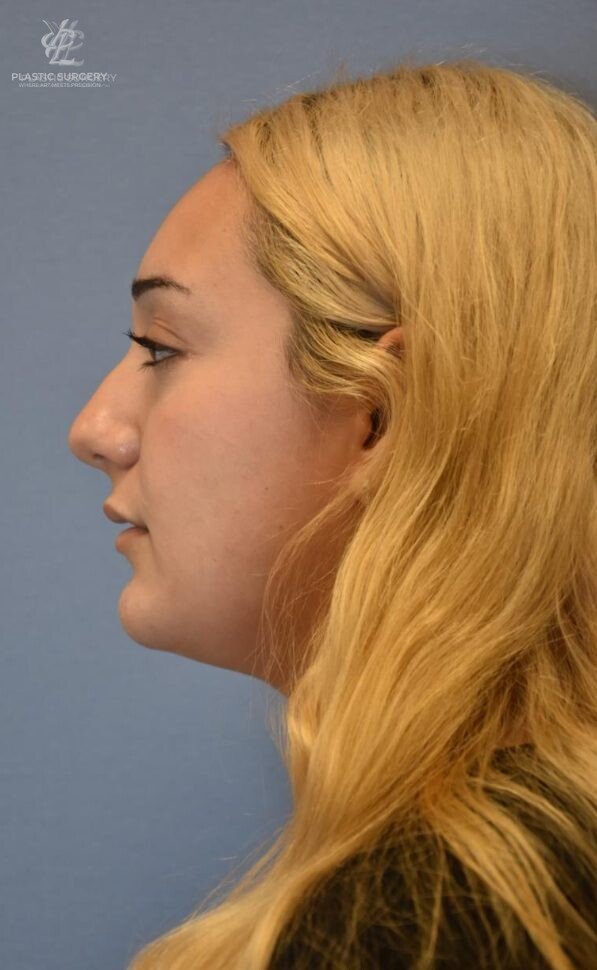 Rhinoplasty, patient 1, before, view 2