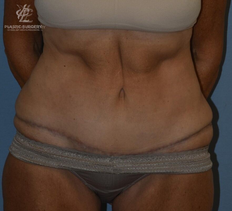 Abdominoplasty (Tummy Tuck), patient 1, after, view 1