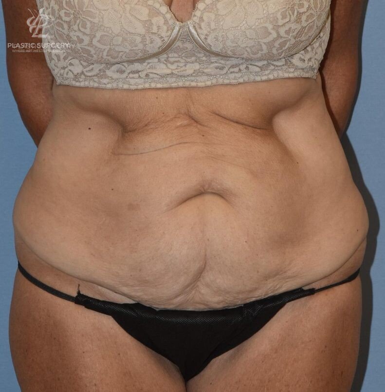 Abdominoplasty (Tummy Tuck), patient 1, before, view 1