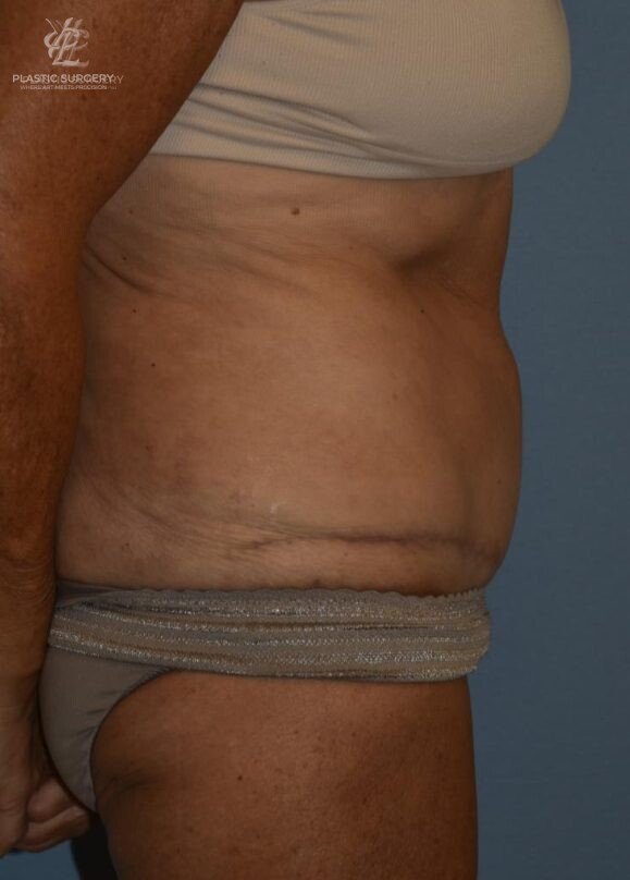 Abdominoplasty (Tummy Tuck), patient 1, after, view 3