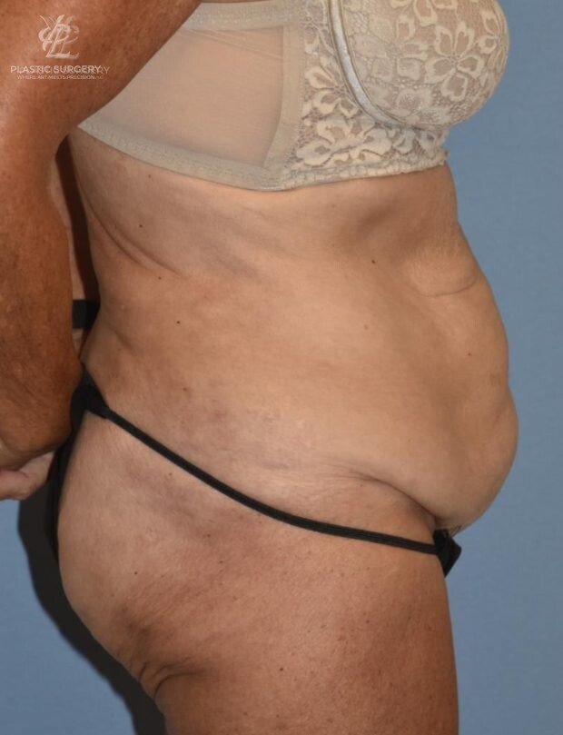 Abdominoplasty (Tummy Tuck), patient 1, before, view 3