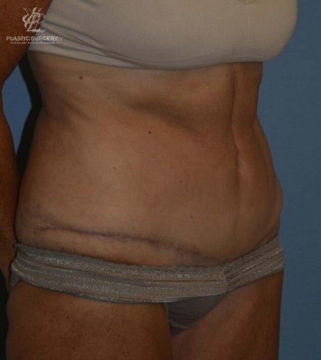 Abdominoplasty (Tummy Tuck), patient 1, after, view 2