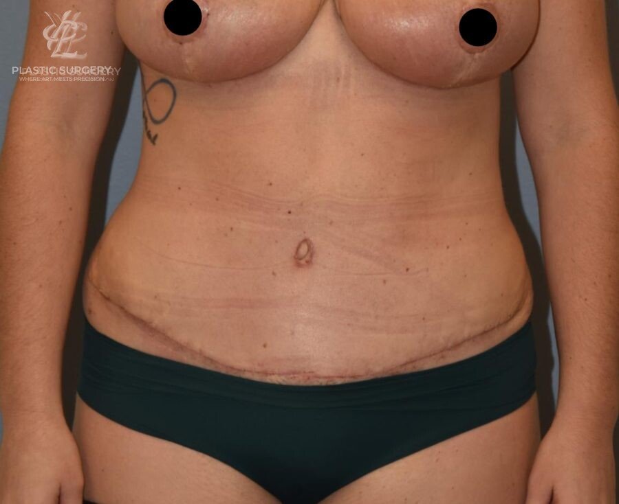 Abdominoplasty (Tummy Tuck), patient 2, after, view 1