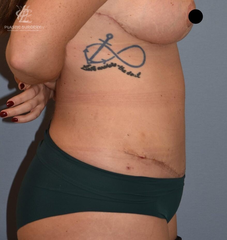 Abdominoplasty (Tummy Tuck), patient 2, after, view 3