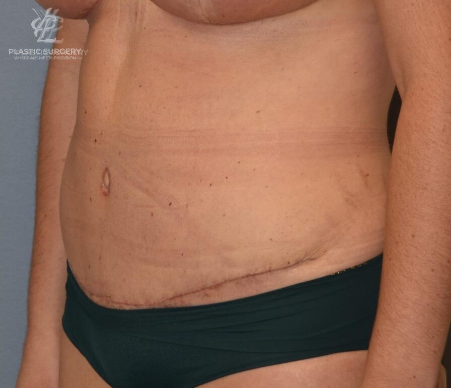 Abdominoplasty (Tummy Tuck), patient 2, after, view 2
