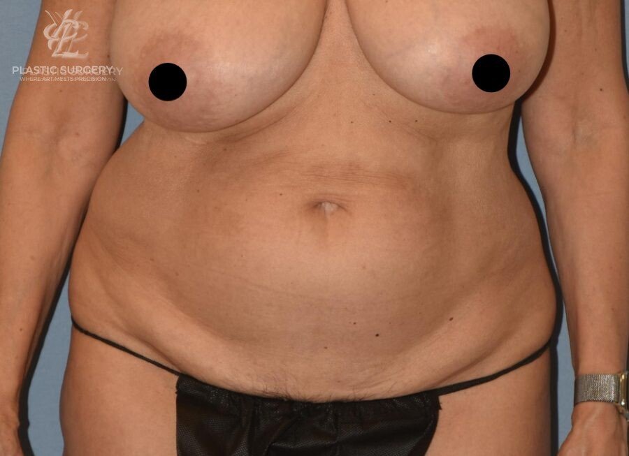 Abdominoplasty (Tummy Tuck), patient 3, before, view 1