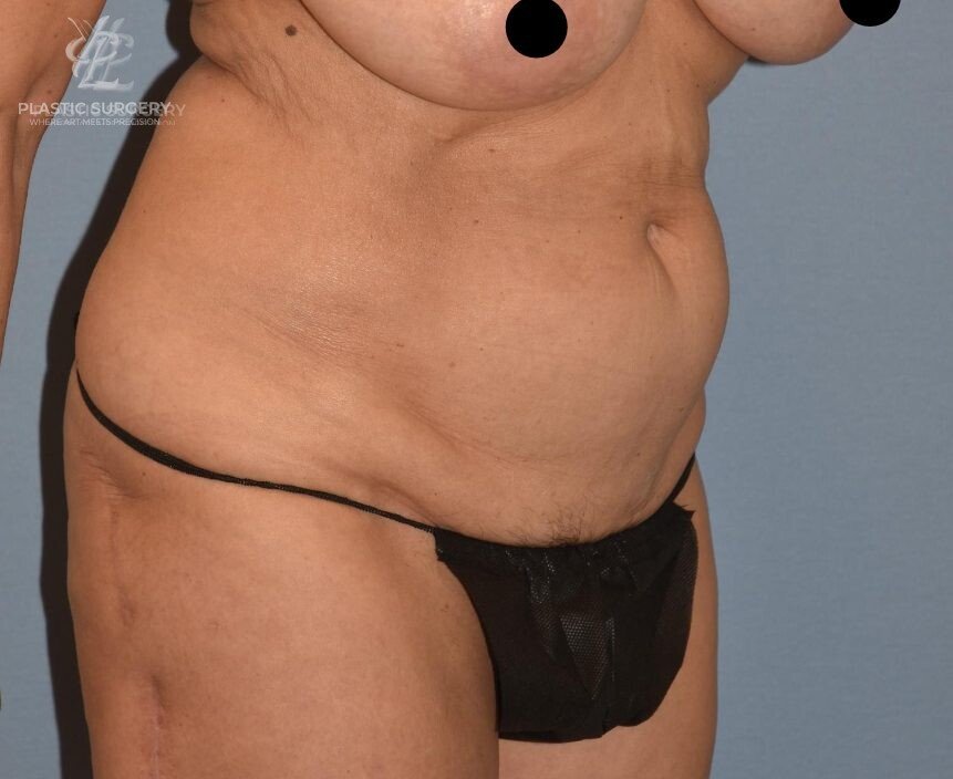 Abdominoplasty (Tummy Tuck), patient 3, before, view 2