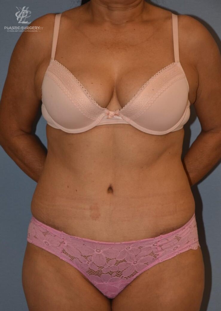 Abdominoplasty (Tummy Tuck), patient 5, after, view 1