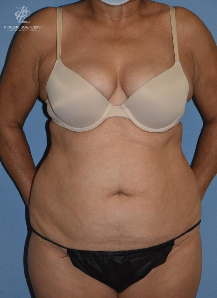 Abdominoplasty (Tummy Tuck), patient 5, before, view 1