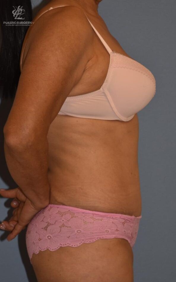 Abdominoplasty (Tummy Tuck), patient 5, after, view 3