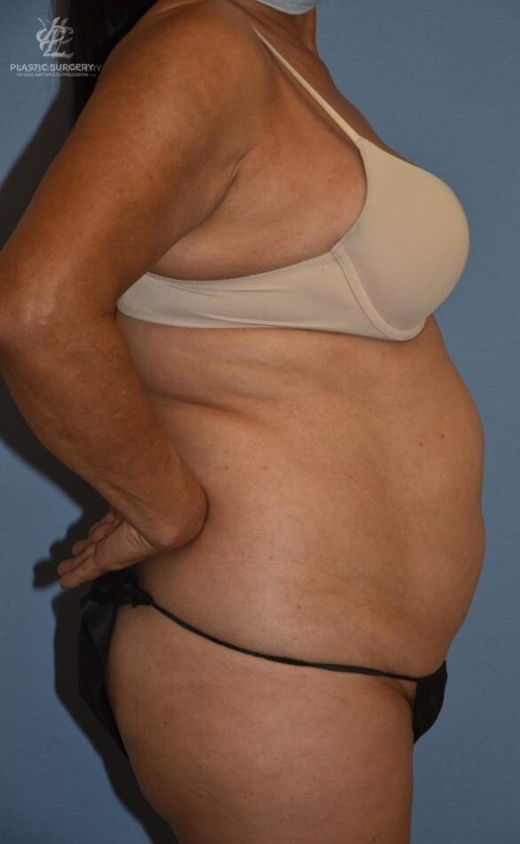 Abdominoplasty (Tummy Tuck), patient 5, before, view 3