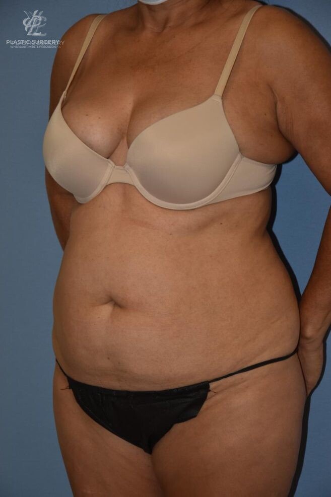 Abdominoplasty (Tummy Tuck), patient 5, before, view 2