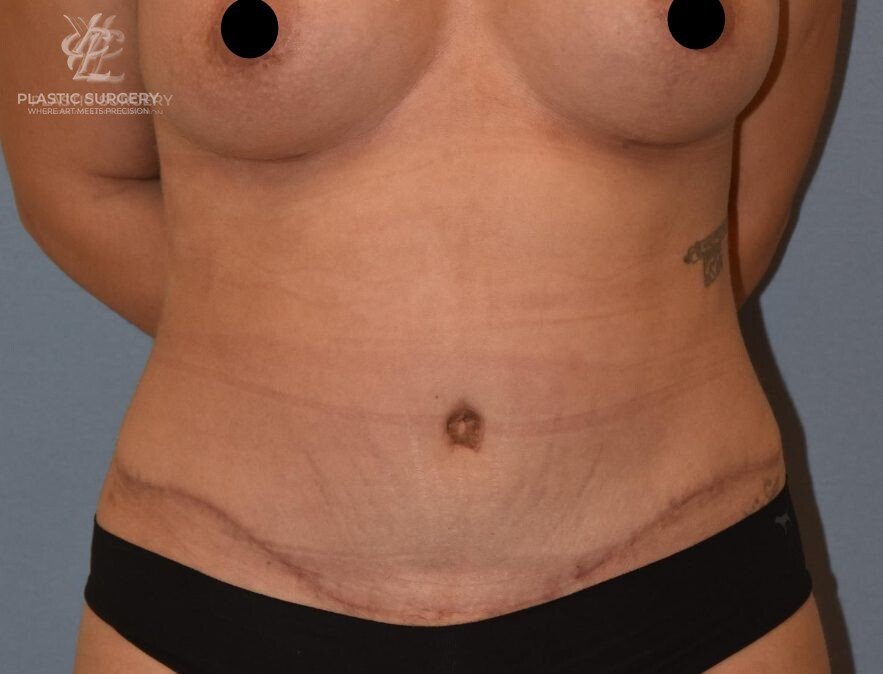 Abdominoplasty (Tummy Tuck), patient 6, after, view 1