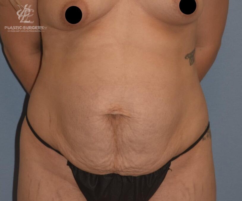 Abdominoplasty (Tummy Tuck), patient 6, before, view 1