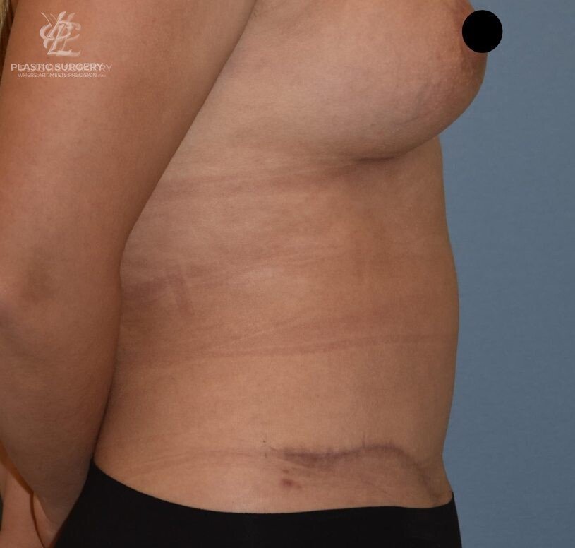 Abdominoplasty (Tummy Tuck), patient 6, after, view 3