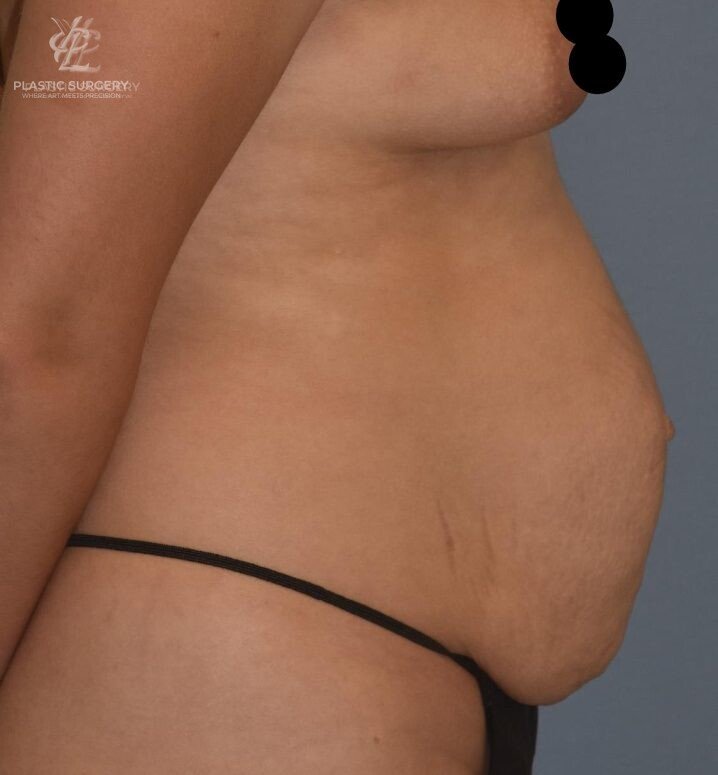 Abdominoplasty (Tummy Tuck), patient 6, before, view 3