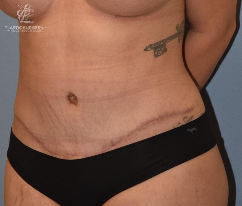 Abdominoplasty (Tummy Tuck), patient 6, after, view 2