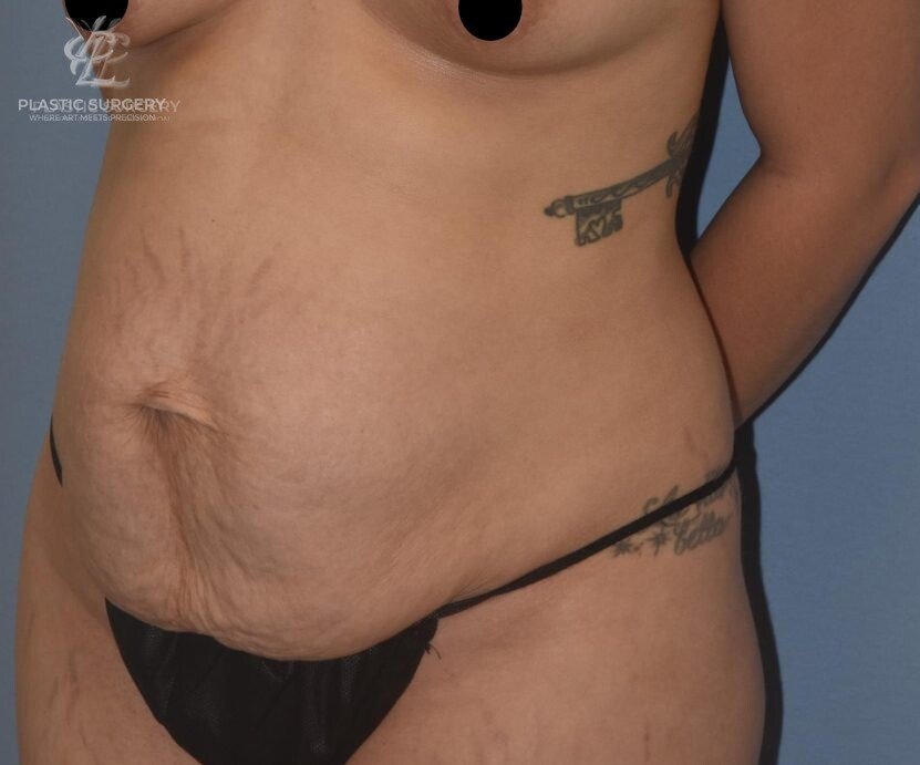 Abdominoplasty (Tummy Tuck), patient 6, before, view 2