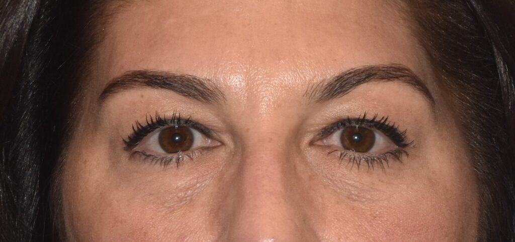 Blepharoplasty (Eyelid Surgery), patient 3, before, view 1