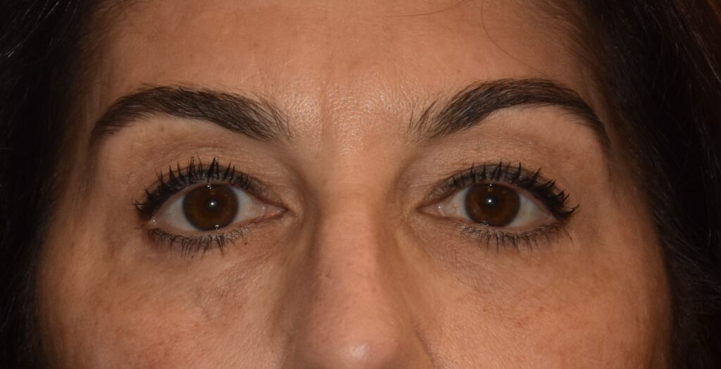 Blepharoplasty (Eyelid Surgery), patient 3, after, view 1