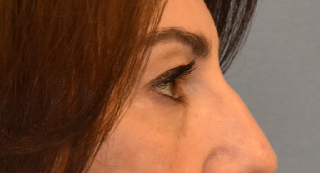 Blepharoplasty (Eyelid Surgery), patient 3, after, view 3