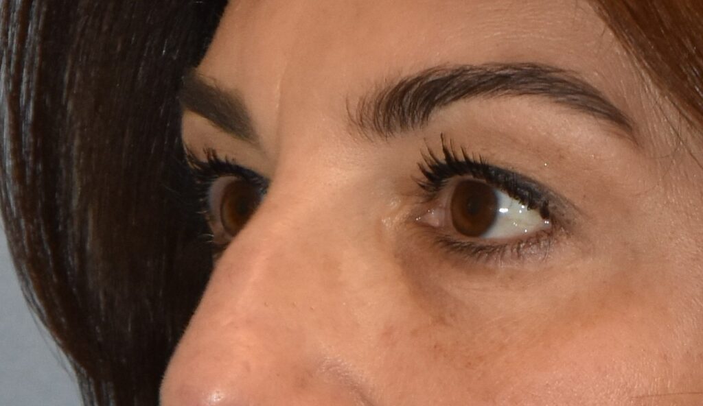 Blepharoplasty (Eyelid Surgery), patient 3, after, view 2