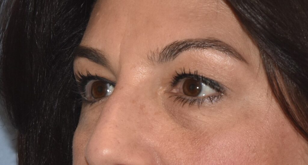 Blepharoplasty (Eyelid Surgery), patient 3, before, view 2
