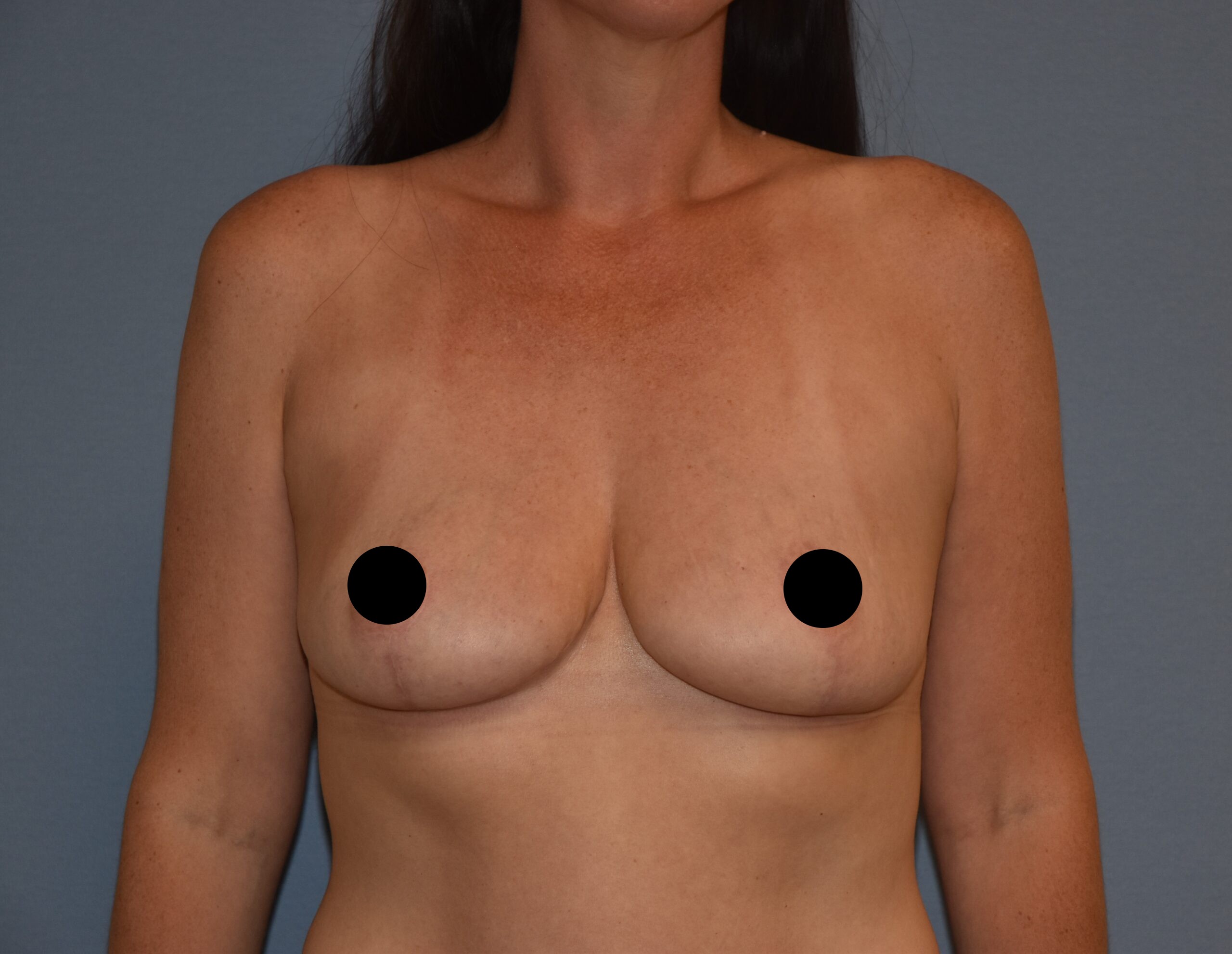 Breast lift (mastopexy) before-and-after result