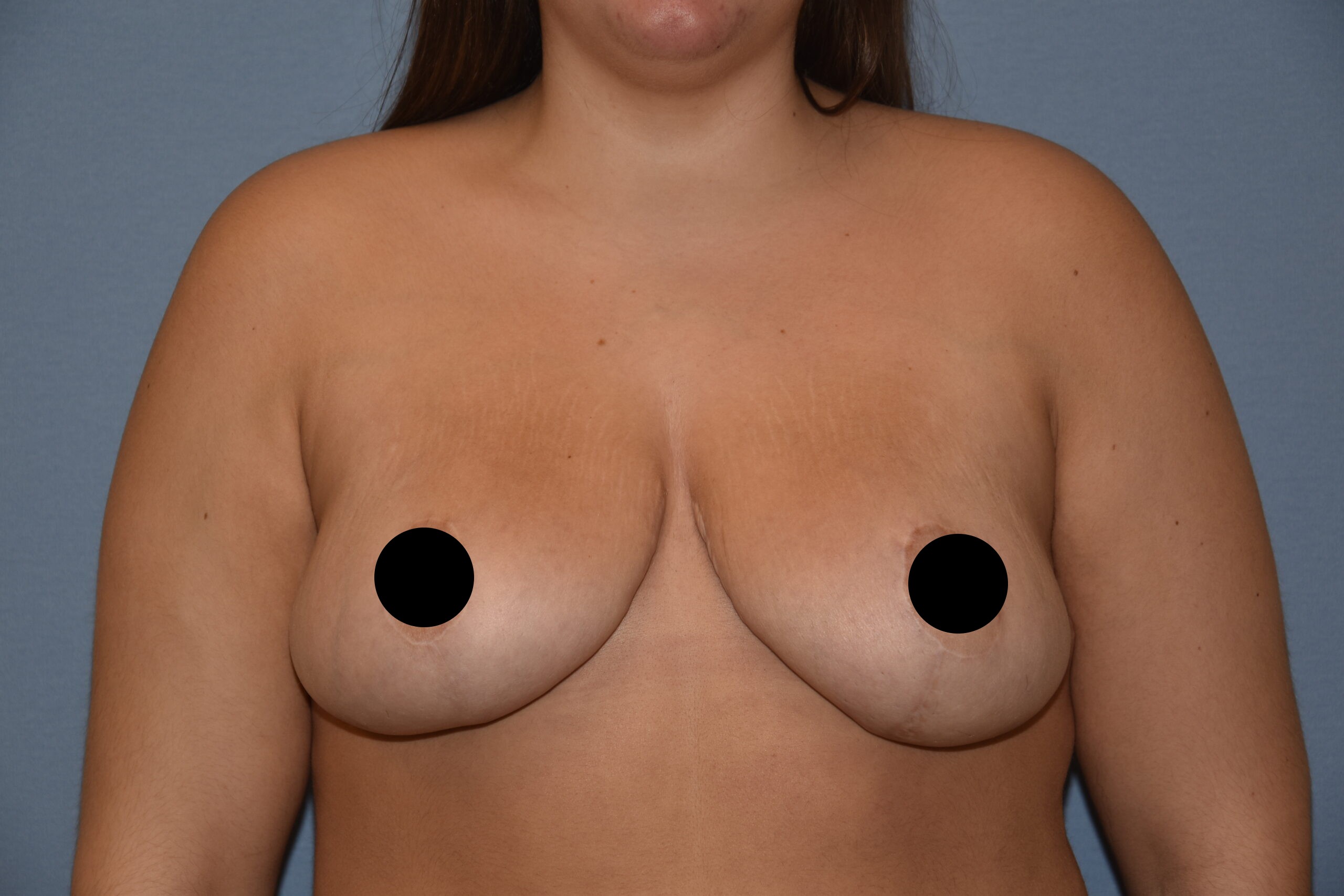 Breast lift (mastopexy) before-and-after result