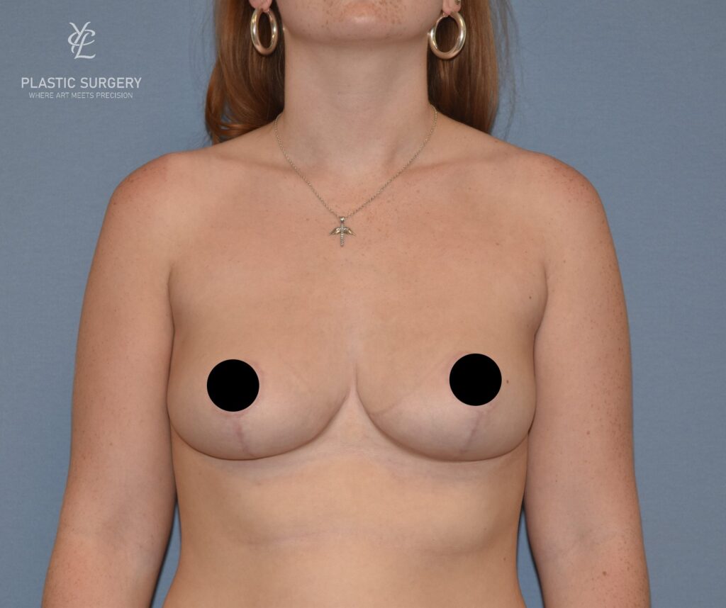 Breast Reduction, patient 13, after, view 1