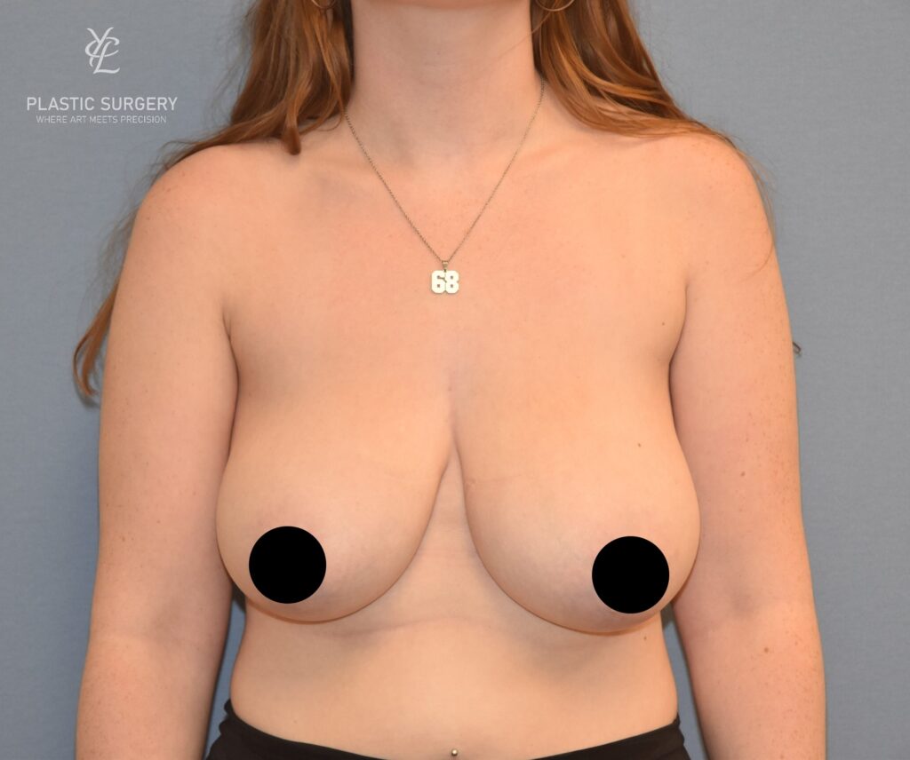 Breast Reduction, patient 13, before, view 1