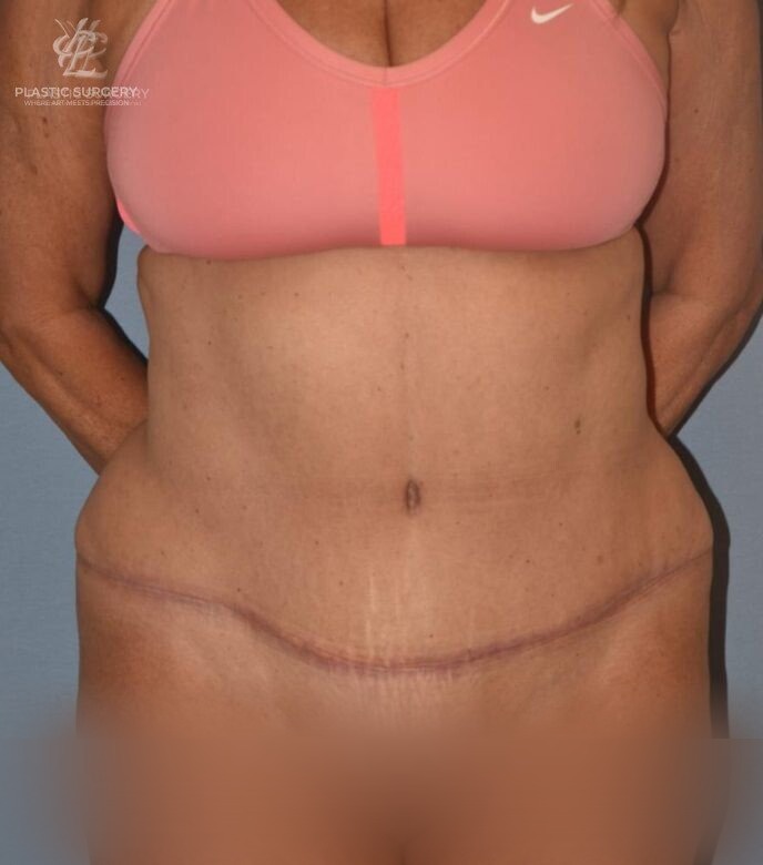 Abdominoplasty (Tummy Tuck), patient 4, after, view 1