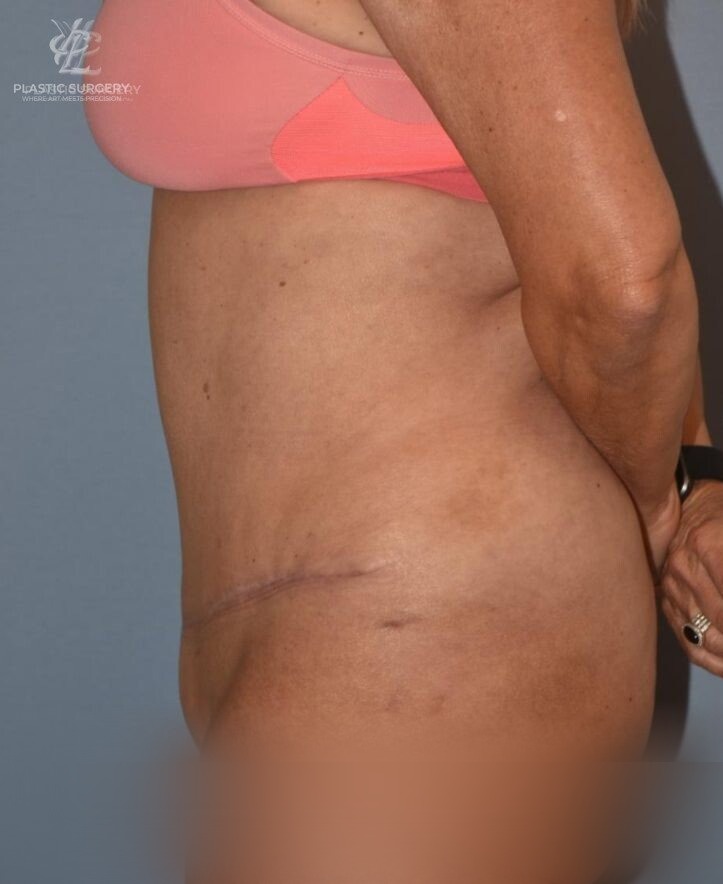 Abdominoplasty (Tummy Tuck), patient 4, after, view 3